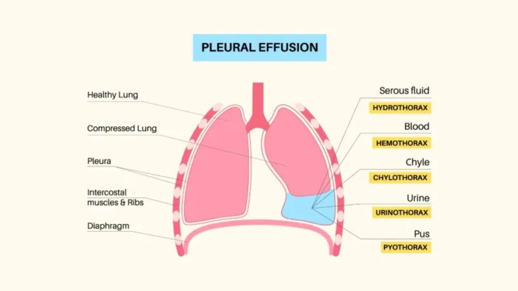 pleural_effusion